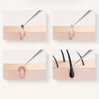 Odorless Stainless Steel Face & Nose Extractor for Whiteheads - Euroselle