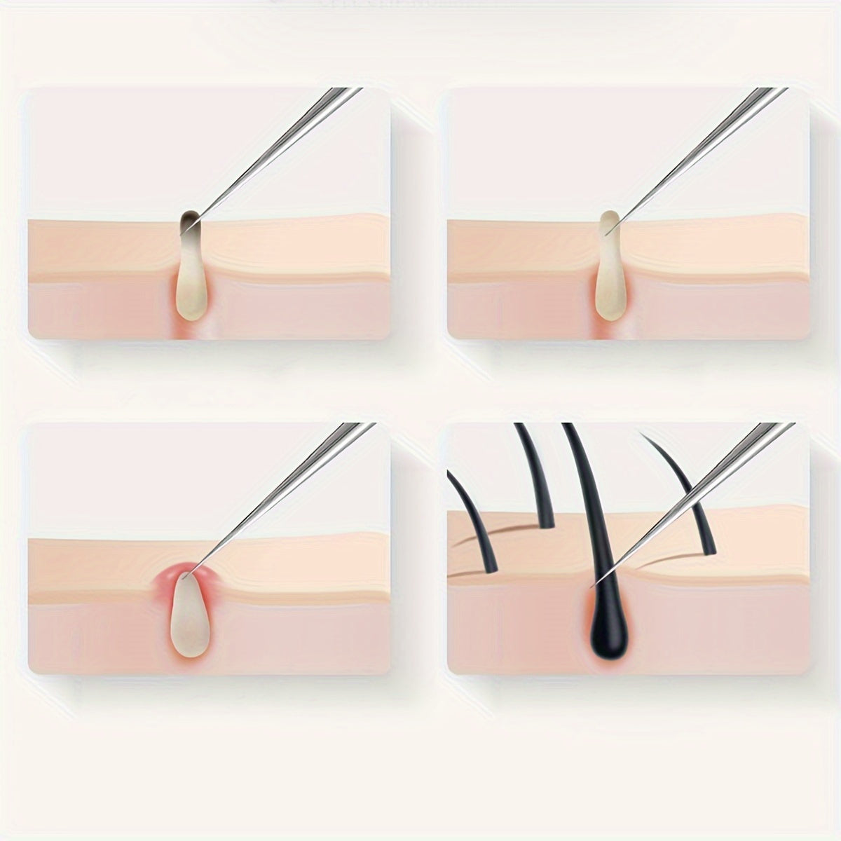 Odorless Stainless Steel Face & Nose Extractor for Whiteheads - Euroselle