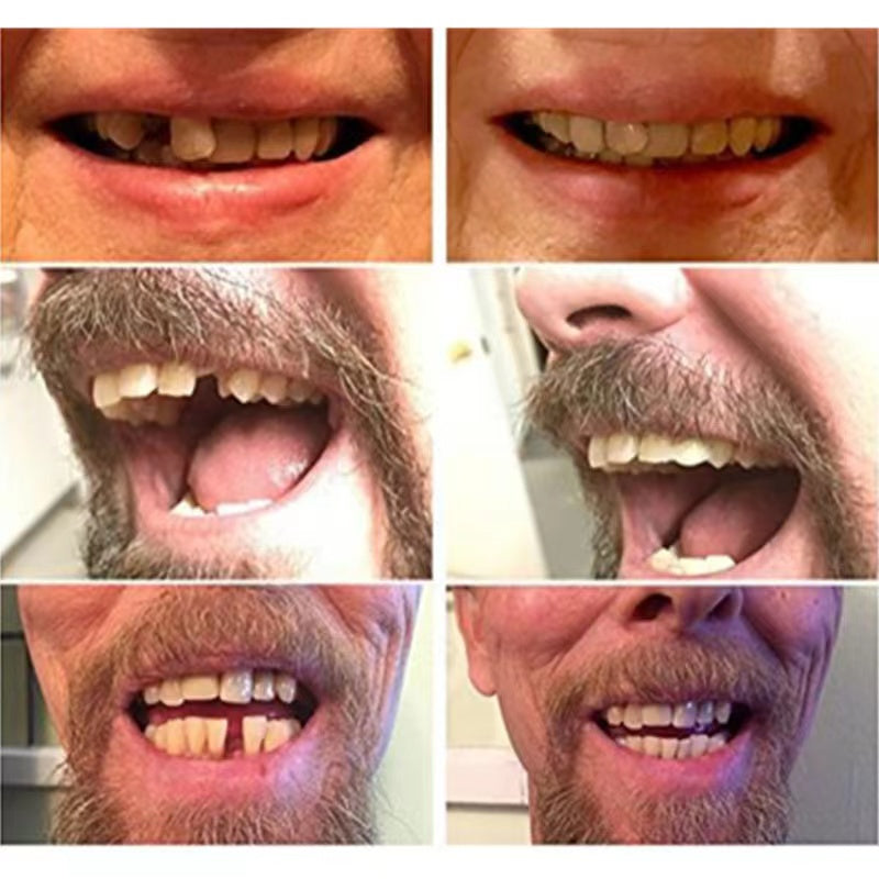 Protesi dentali estetiche provvisorie per un sorriso naturale | Euroselle