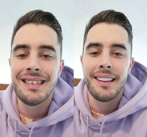 Faccette dentali Instant Smile – arcata superiore e inferiore incluse | Euroselle